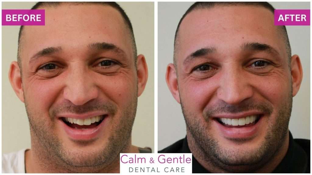 cosmetic dentistry veneers tonbridge dentist