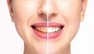 teeth whitening as solution for stained teeth