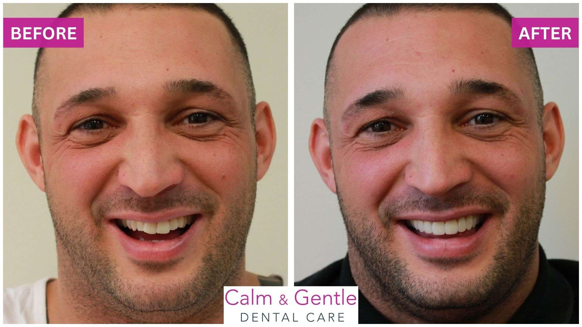 cosmetic dentistry veneers tonbridge dentist