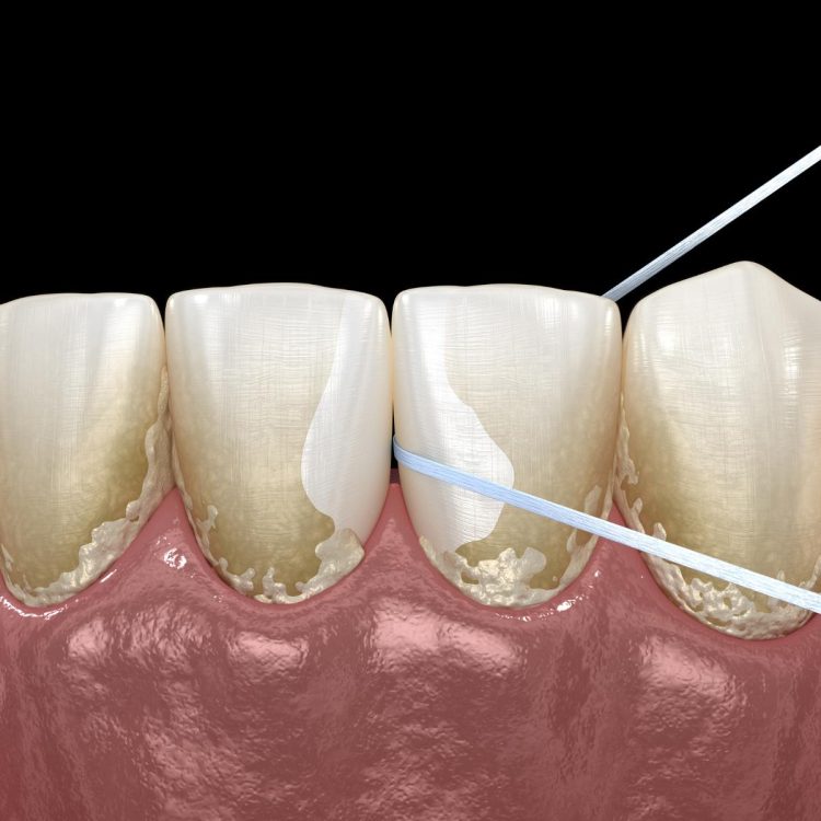 dental plaque being removed from teeth