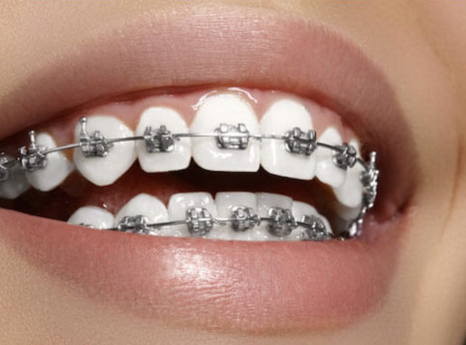 woman wearing braces