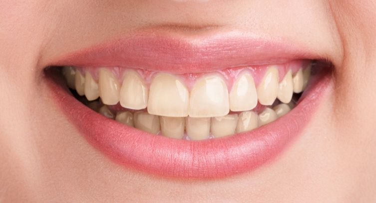 woman with yellow teeth before whitening treatment