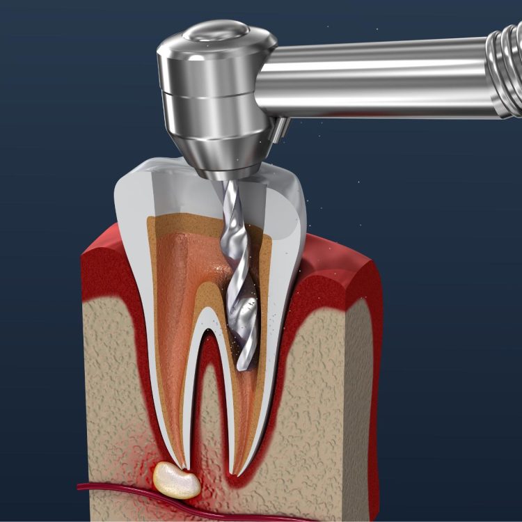 image of root canal