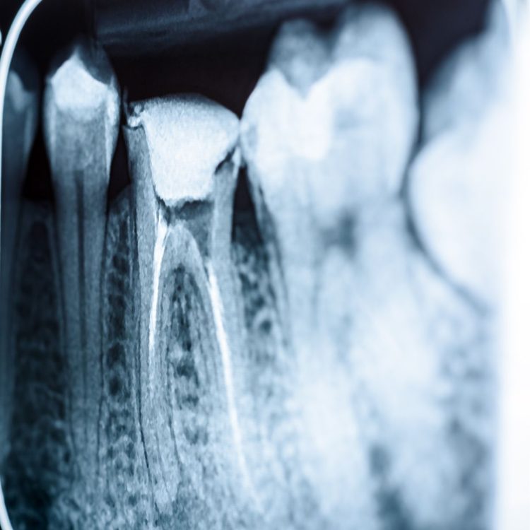 image of teeth xray