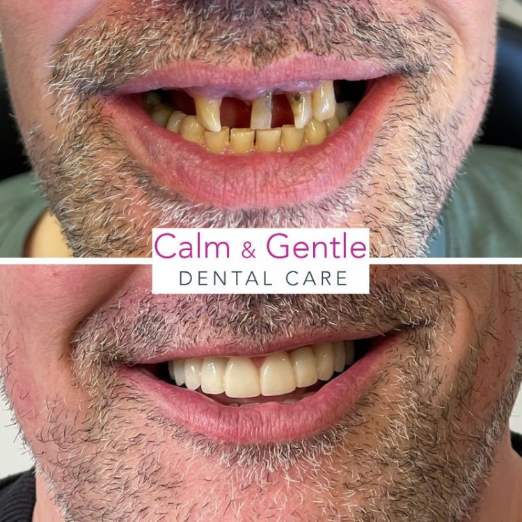before and after dental implants in tonbridge